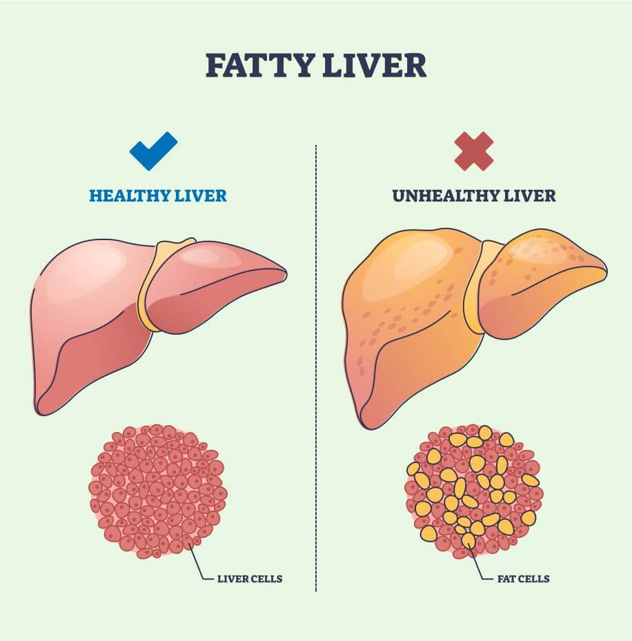 Fatty liver