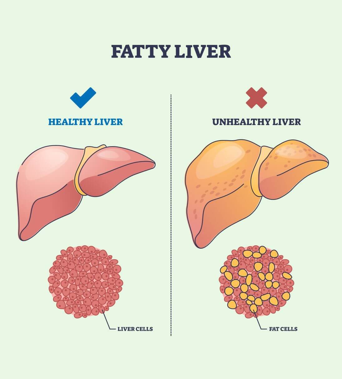 Fatty liver